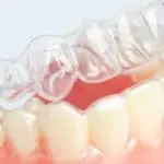 clear aligner on teeth